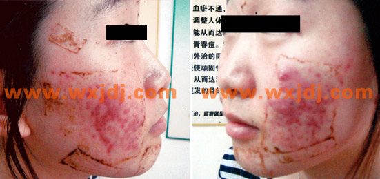 青春痘患者案例